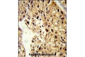 Formalin-fixed and paraffin-embedded human hepatocarcinoma reacted with PCBD1 Antibody (Center), which was peroxidase-conjugated to the secondary antibody, followed by DAB staining.