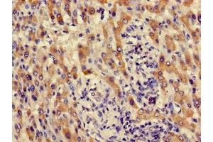 Immunohistochemistry of paraffin-embedded human liver cancer using ABIN7142142 at dilution of 1:100 (ACMSD anticorps  (AA 33-129))