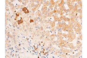ABIN6267224 at 1/100 staining human vascular cancer tissue sections by IHC-P. (CHEK1 anticorps  (pSer317))