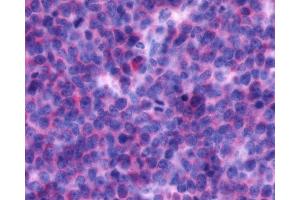 Anti-CXCR4 antibody IHC of human Lymph Node, Non-Hodgkins Lymphoma.