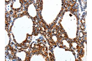 The image on the left is immunohistochemistry of paraffin-embedded Human thyroid cancer tissue using ABIN7191529(MTNR1A Antibody) at dilution 1/40, on the right is treated with synthetic peptide. (Melatonin Receptor 1A anticorps)