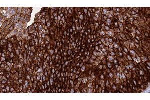 ABIN6276414 at 1/100 staining Human urothelial cancer tissue by IHC-P. (ERBB3 anticorps  (C-Term))