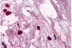 Human Breast, Mast Cells (formalin-fixed, paraffin-embedded) stained with TPSAB1 antibody ABIN337075 at 2. (TPSAB1 anticorps)