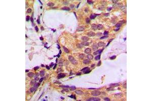 Immunohistochemical analysis of Histone Deacetylase 6 staining in human breast cancer formalin fixed paraffin embedded tissue section. (HDAC6 anticorps  (N-Term))