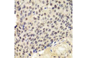 Immunohistochemistry of paraffin-embedded human lung cancer using KPNA1 antibody.