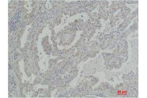 Immunohistochemistry (IHC) analysis of paraffin-embedded Human Lung Carcinoma using Akt2 Polyclonal Antibody. (AKT2 anticorps)