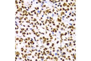 Immunohistochemistry of paraffin-embedded Human kidney cancer using H3K9me2 antibody at dilution of 1:100 (x400 lens).