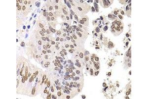 Immunohistochemistry of paraffin-embedded Human colon carcinoma using SOX5 Polyclonal Antibody at dilution of 1:100 (40x lens).