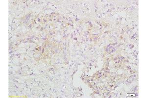 Formalin-fixed and paraffin embedded human gastric carcinoma tissue labeled with Anti-TRAF3/CD40bp Polyclonal Antibody, Unconjugated  at 1:200 followed by conjugation to the secondary antibody and DAB staining