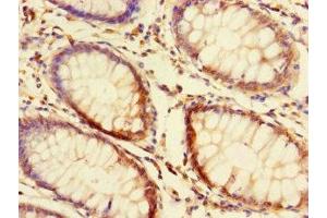 Immunohistochemistry of paraffin-embedded human colon cancer using ABIN7165390 at dilution of 1:100 (FAM131A anticorps  (AA 1-281))