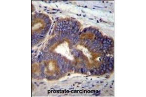 Y Antibody (C-term) (ABIN655601 and ABIN2845085) immunohistochemistry analysis in formalin fixed and paraffin embedded human prostate carcinoma followed by peroxidase conjugation of the secondary antibody and DAB staining. (YI016 (AA 253-280), (C-Term) anticorps)