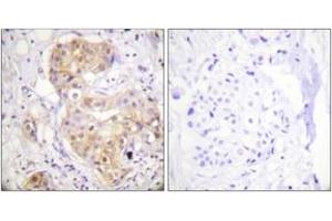 Immunohistochemistry analysis of paraffin-embedded human breast carcinoma tissue, using PKC delta (Ab-505) Antibody. (PKC delta anticorps  (AA 471-520))