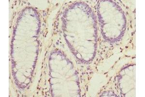 Immunohistochemistry of paraffin-embedded human colon cancer using ABIN7170671 at dilution of 1:100 (SKAP2 anticorps  (AA 1-120))