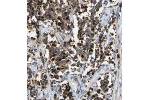 Immunohistochemistry analysis of paraffin-embedded human cervical cancer using BACH1 antibody at dilution of 1/100. (BACH1 anticorps)