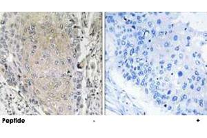 Immunohistochemistry analysis of paraffin-embedded human lung carcinoma tissue using CBLN3 polyclonal antibody . (CBLN3 anticorps)