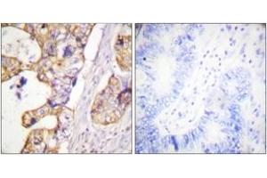 Immunohistochemistry analysis of paraffin-embedded human colon carcinoma tissue, using Keratin 8 (Ab-431) Antibody. (KRT8 anticorps  (AA 401-450))