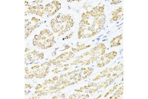 Immunohistochemistry of paraffin-embedded human colon carcinoma using CREB1 antibody (ABIN6290133) at dilution of 1:100 (40x lens).