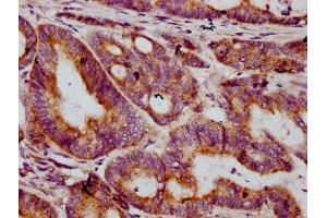 IHC image of ABIN7149158 diluted at 1:400 and staining in paraffin-embedded human colon cancer performed on a Leica BondTM system.