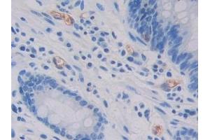 Detection of GC in Human Stomach cancer Tissue using Polyclonal Antibody to Glycocalicin (GC) (Glycocalicin anticorps  (AA 136-276))