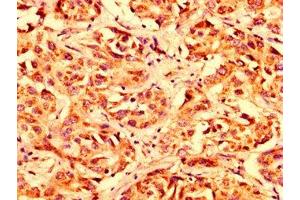 IHC image of ABIN7159933 diluted at 1:300 and staining in paraffin-embedded human liver cancer performed on a Leica BondTM system.