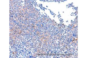 Immunohistochemistry of Human ovarian cancer using PTK2 Polyclonal Antibody at dilution of 1:75 (FAK anticorps)