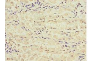Immunohistochemistry of paraffin-embedded human gastric cancer using ABIN7168157 at dilution of 1:100 (Ribose 5-Phosphate Isomerase A (RPIA) (AA 82-311) anticorps)