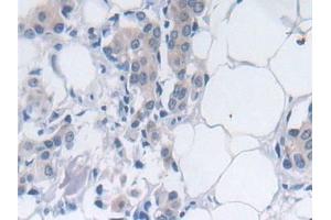 Detection of SRY in Human Breast cancer Tissue using Polyclonal Antibody to Sex Determining Region Y (SRY) (SRY anticorps  (AA 1-204))