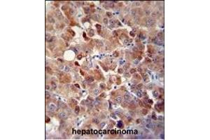 CHRDL1 antibody (N-term) (ABIN654624 and ABIN2844321) immunohistochemistry analysis in formalin fixed and paraffin embedded human hepatocarcinoma followed by peroxidase conjugation of the secondary antibody and DAB staining. (CHRDL1 anticorps  (N-Term))