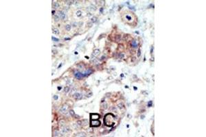 Formalin-fixed and paraffin-embedded human cancer tissue reacted with the primary antibody, which was peroxidase-conjugated to the secondary antibody, followed by DAB staining.