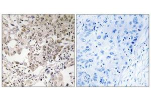 Immunohistochemistry analysis of paraffin-embedded human lung carcinoma tissue using NCAPG2 antibody. (NCAPG2 anticorps  (Internal Region))