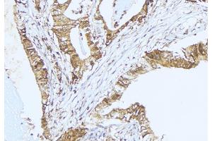 ABIN6275352 at 1/100 staining Human lung cancer tissue by IHC-P. (PEX2 anticorps  (Internal Region))