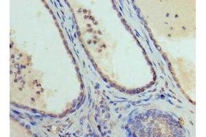 Immunohistochemistry of paraffin-embedded human prostate cancer using ABIN7152009 at dilution of 1:100