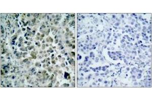 Immunohistochemistry analysis of paraffin-embedded human lung carcinoma tissue, using HDAC8 (Ab-39) Antibody. (HDAC8 anticorps  (AA 5-54))