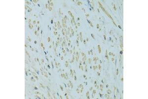 Immunohistochemistry of paraffin-embedded human uterine cancer using UGT1A6 antibody. (UGT1A6 anticorps)