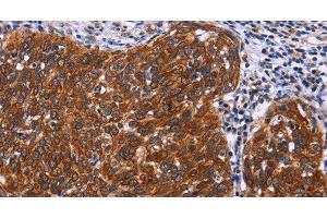 Immunohistochemistry of paraffin-embedded Human cervical cancer tissue using USP2 Polyclonal Antibody at dilution 1:40 (USP2 anticorps)
