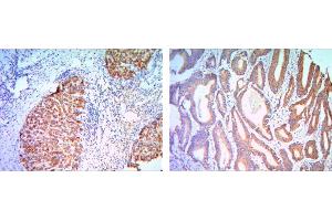 Immunohistochemical analysis of paraffin-embedded liver cancer (right) and colon cancer tissues (left) using KLHL11 mouse mAb with DAB staining. (KLHL11 anticorps)
