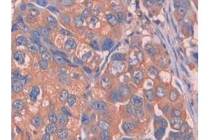 IHC-P analysis of Human Breast cancer Tissue, with DAB staining. (Complement Factor B anticorps  (AA 35-160))