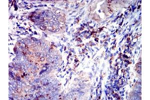 Immunohistochemical analysis of paraffin-embedded rectum cancer tissues using CD53 mouse mAb with DAB staining. (CD53 anticorps)
