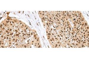 Immunohistochemistry of paraffin-embedded Human esophagus cancer tissue using FBXO32 Polyclonal Antibody at dilution of 1:60(x200)