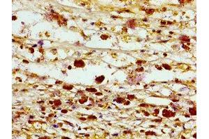 Immunohistochemistry of paraffin-embedded human melanoma using ABIN7161402 at dilution of 1:100