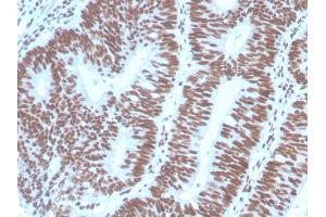 Formalin-fixed, paraffin-embedded human Colon Carcinoma stained with PAX2 Mouse Monoclonal Antibody (PAX2/1104). (PAX2A anticorps  (AA 223-354))