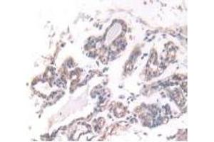 Detection of IFNa5 in Human Breast Cancer Tissue using Monoclonal Antibody to Interferon Alpha 5 (IFNa5)