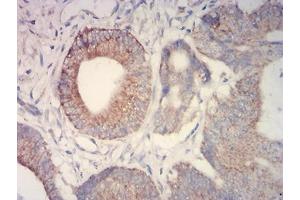 Immunohistochemical analysis of paraffin-embedded colon cancer tissues using IDH2 mouse mAb with DAB staining. (IDH2 anticorps  (AA 1-143))