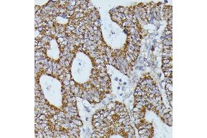 Immunohistochemistry of paraffin-embedded human colon carcinoma using FLII antibody (ABIN7267217) at dilution of 1:100 (40x lens).