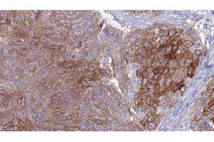 ABIN6276957 at 1/100 staining Human urothelial cancer tissue by IHC-P. (Macrophage Scavenger Receptor 1 anticorps  (N-Term))