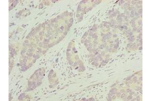 Immunohistochemistry of paraffin-embedded human gastric cancer using ABIN7163654 at dilution of 1:100 (GNRPX anticorps  (AA 1-149))