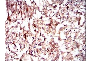 Immunohistochemical analysis of paraffin-embedded renal cancer tissues using GUCY1A3 mouse mAb with DAB staining.