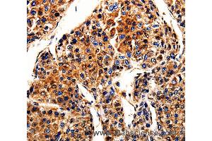 Immunohistochemistry of Human liver cancer using APLP1 Polyclonal Antibody at dilution of 1:10