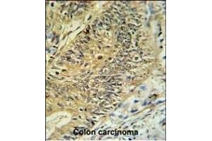 RPS15A Antibody (N-term) (ABIN650999 and ABIN2840032) IHC analysis in formalin fixed and paraffin embedded colon carcinoma followed by peroxidase conjugation of the secondary antibody and DAB staining. (RPS15A anticorps  (N-Term))