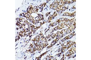 Immunohistochemistry of paraffin-embedded human breast cancer using VD Rabbit pAb (ABIN7271337) at dilution of 1:150 (40x lens). (VDAC2 anticorps  (AA 1-100))